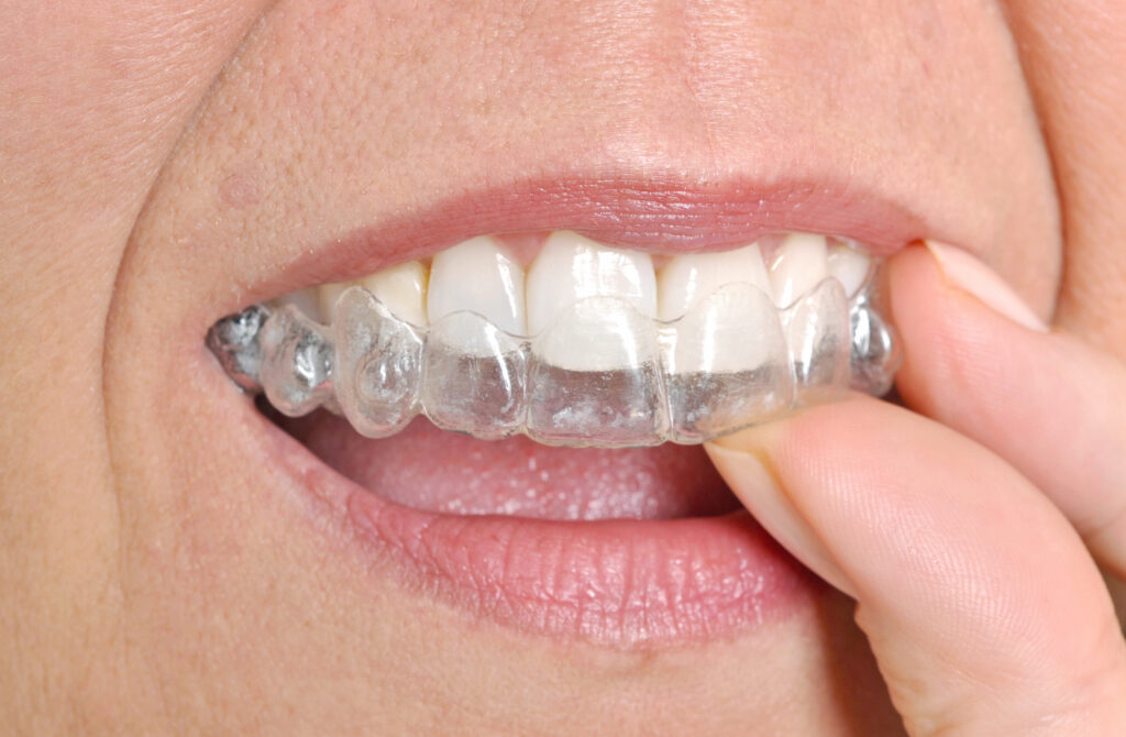 Invisalign